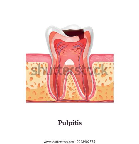 Pulpitis Stage Tooth Destruction Realistic Vector Stock Vector Royalty