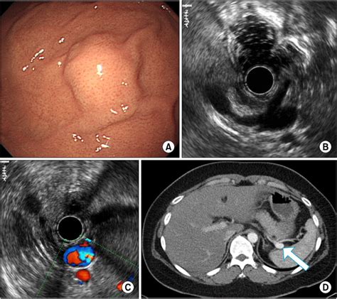 A Case Of Extraluminal Impression Presented As Subepithelial Lesion Download Scientific