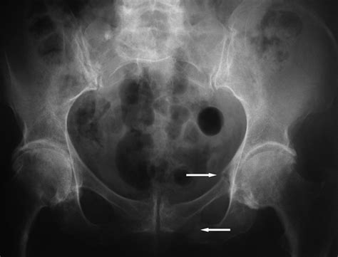 Percutaneous Screw Fixation For Sacral Insufficiency Fractures Bone