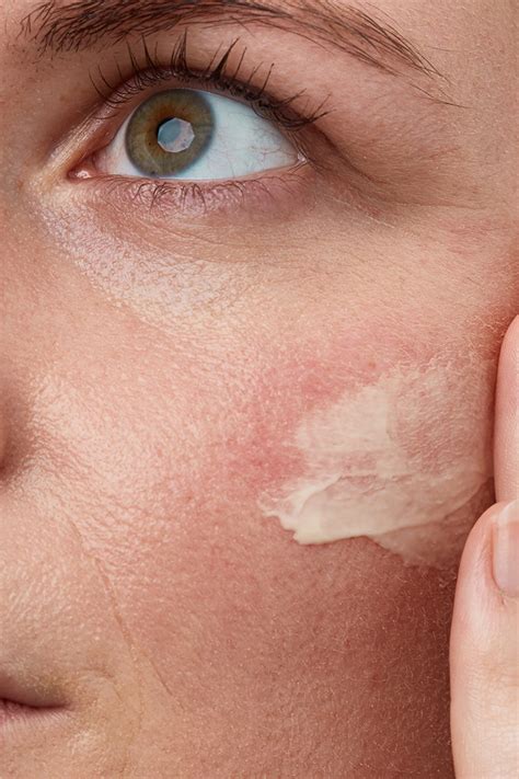Suffer From Eczema Heres Exactly How To Approach Your Skincare Routine