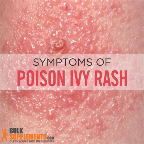 Poison Ivy Rash Stages Causes Symptoms And Treatment