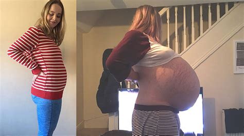 Elle pensait être enceinte mais elle avait un kyste de kilos dans le ventre