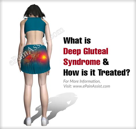 What Is Deep Gluteal Syndrome And How Is It Treated
