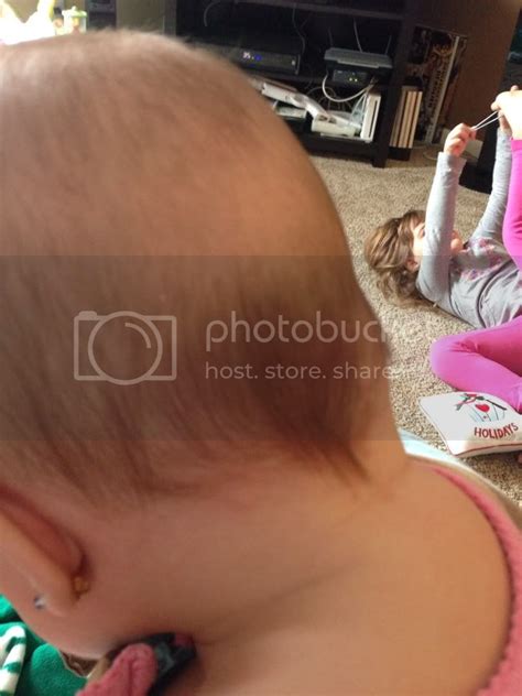 Help Strange Lump On Back Of Head Pic Babycenter