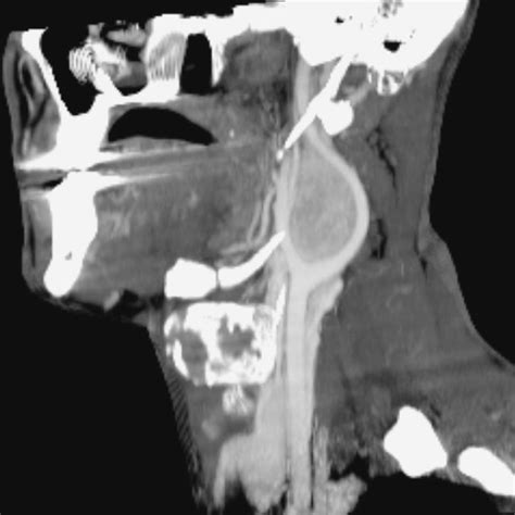 Paragangliomas Of The Head And Neck Pacs