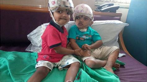 First In India Jagga And Balia Conjoined Twins Born With Brains Fused