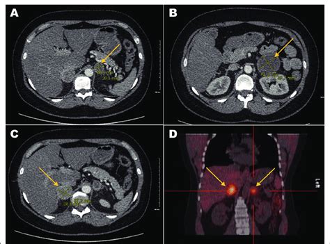 Imaging Of The Clinical Case Abdominal Computed Tomography Ct Scan