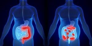 Ulcerative Colitis Vs Crohn 39 S Disease What 39 S The Difference