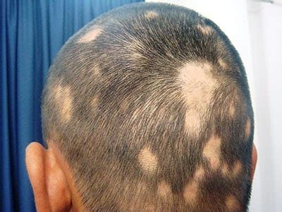 What are the symptoms of alopecia/hairloss? Alopecia Areata (Hair Loss) | Causes & Homeopathic Treatment