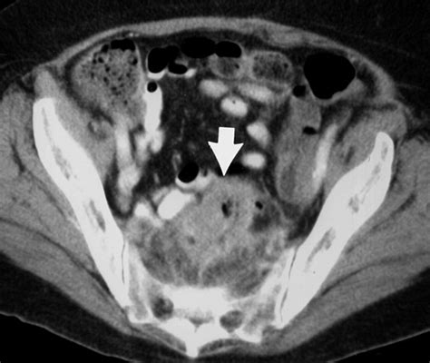 Spiral Ct Of Colon Cancer Imaging Features And Role In Management