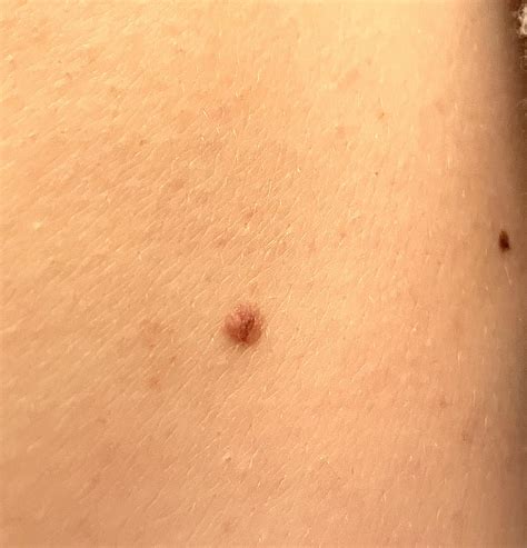 Middle Of My Back Ive Had This Mole My Whole Life But Have Recently