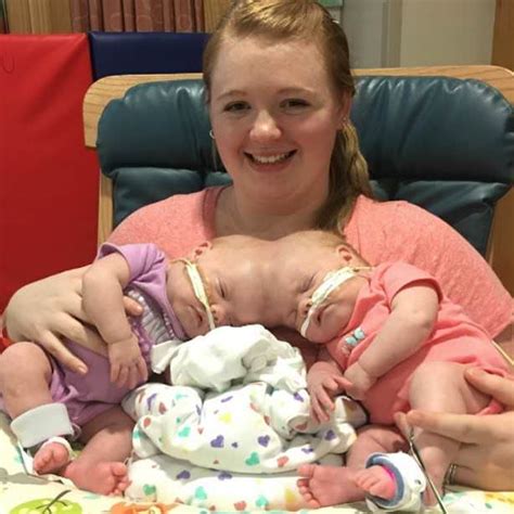 bliźniaczki syjamskie urodziły się połączone głowami zobacz jak wyglądają dwa lata po rozłączeniu