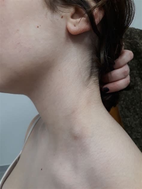 Neck And Supraclavicular Lymphadenopathy Secondary To 9 Valent Human