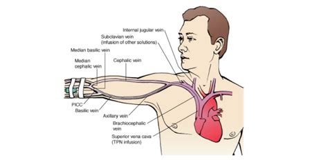 Parenteral nutrition (pn) support refers to the provision of calories, amino acids, electrolytes, vitamins, minerals, trace elements, and fluids via guidelines suggest that when tolerance to enteral nutrition is evident, parenteral nutrition should be weaned and discontinued when >60 percent of the patients'. Which precaution should you implement if a patient is ...