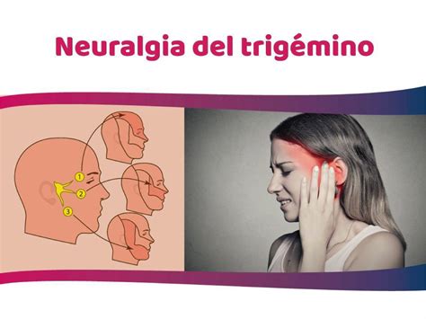 Neuralgia Del Trigémino Efectivo Tratamiento Para El Alivio Del Dolor