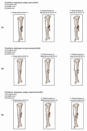 Tibial Shaft Fractures Intramedullary Nailing Musculoskeletal Key