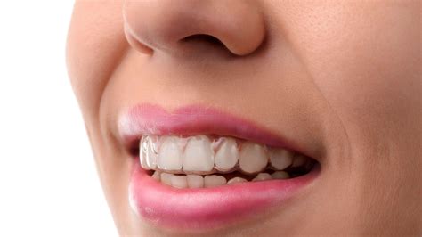 About Invisalign Part 2 Krystal Dental