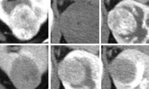 Algorithm Differentiates Small Renal Masses On Multiphase Ct