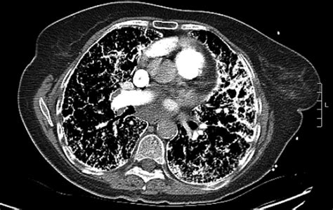 Ct Scan Of The Chest Without Contrast Showing Diffuse Ground Glass
