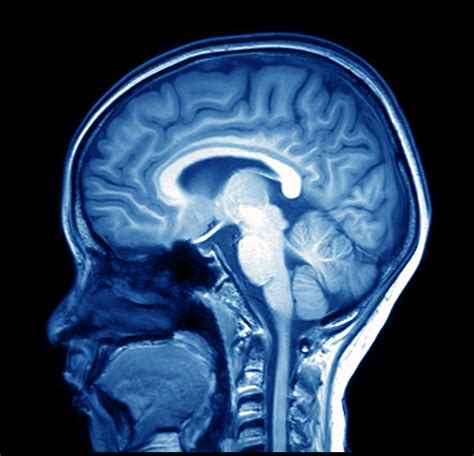 Magnetic Resonance Image Mri Of The Brain Odc