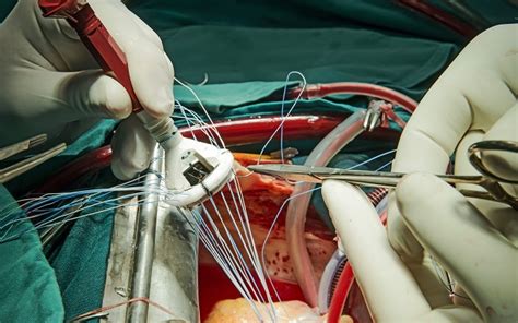 New Surgical Valve Durability Data Set ‘critical Benchmark For Tavr