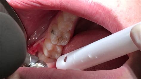 Surgical Extraction Of Horizontally Impacted 38 Wisdom Tooth