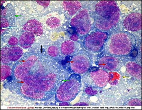 Anaplastic Large Cell Lymphoma Alk Positive Cell Atlas Of Haematological Cytology