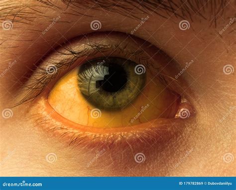 Yellow Staining Of The Sclera Of The Eye In Diseases Of The Liver Cirrhosis Hepatitis Royalty