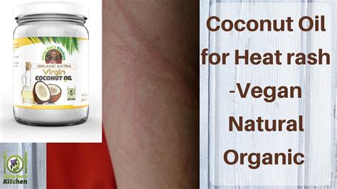 Coconut Oil For Heat Rash Werohmedia