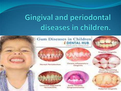Ppt Gingival And Periodontal Diseases In Children Powerpoint