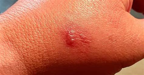 False Widow Spider Bite Leaves Spooked Mans Arm Itching And Swelled
