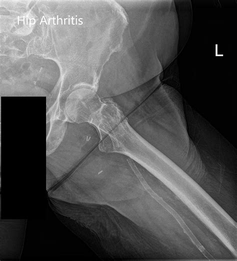 X Ray Left Hip