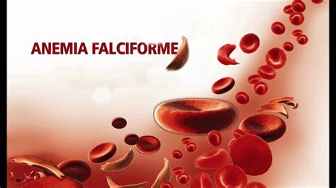 Caso Clínico 2 2 Enfermedad Anemia Falciforme Youtube