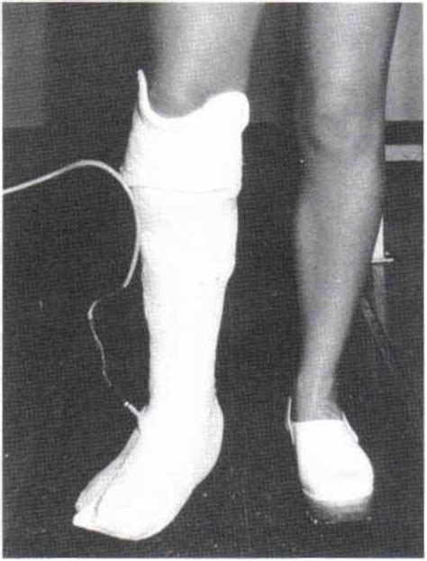 Rotating lower leg is ok cast is long on the knee so the foot remains stable. Fig. 2. One of the volunteers with PTB plaster | O&P ...