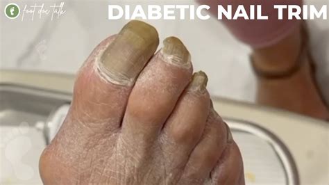 Diabetic Nail Trim Youtube