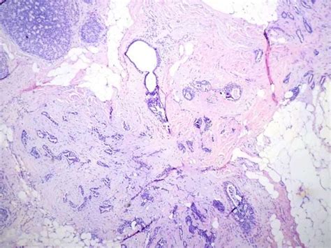 Complex Fibroadenoma With Atypical Ductal Hyperplasia Bosnianpathology