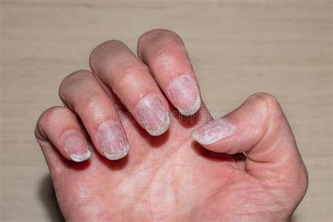 Flaky Bitten And Brittle Nails Without A Manicure Regrown Nail Cuticle