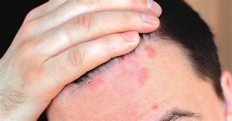 Red Spots On Scalp Pictures Causes And Treatments Medical News Today