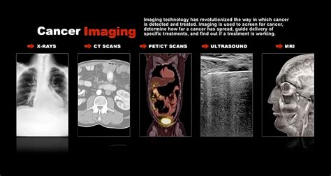How Is Childhood Rhabdomyosarcoma Diagnosed? - StoryMD