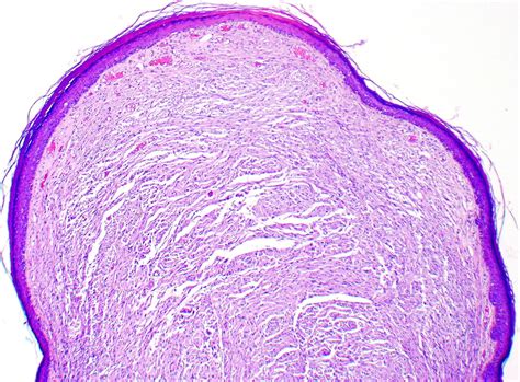 Mucosal Neuroma Histology