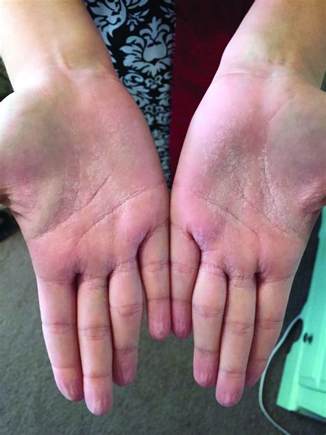 A Woman With An Asymptomatic Eruption On Her Palms After Exposure To