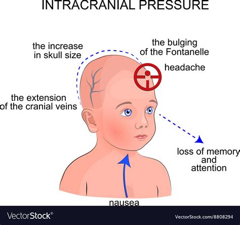 Symptoms Intracranial Pressure In Children Vector Image
