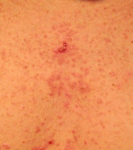 Fungal Acne Treatments Symptoms And Difference From Acne Goodrx