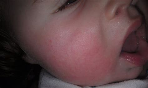 Maybe you would like to learn more about one of these? Does this look like an allergic reaction? *pics* - BabyCenter