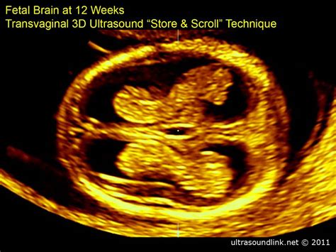 Fetal Brain At 12 Weeks 3d Scan Youtube