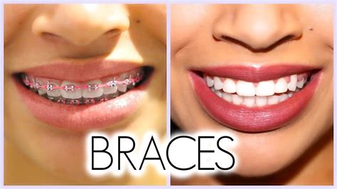 Teeth Brace Before And After