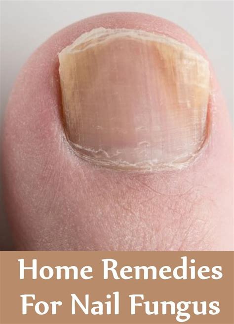 7 Effective Home Remedies For Nail Fungus Nagelpilz Hausmittel