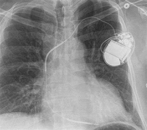 Radiography Of Cardiac Conduction Devices A Comprehensive Review