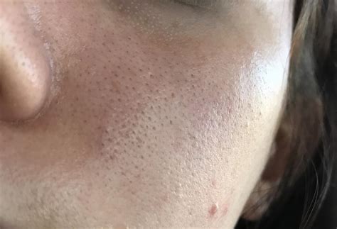 Orange Peel Skin Disaster W Pictures Page 3 General Acne Discussion Forum