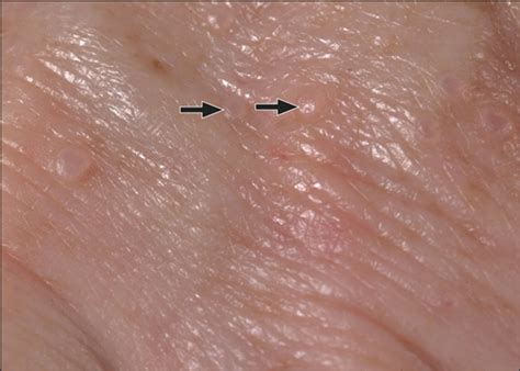 Multiple Painless Papules On The Wrists—quiz Case Dermatology Jama